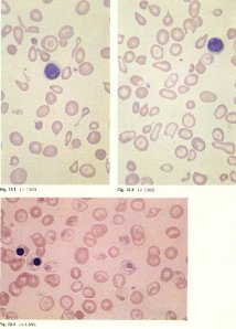 Sangre afectada por beta talasemia